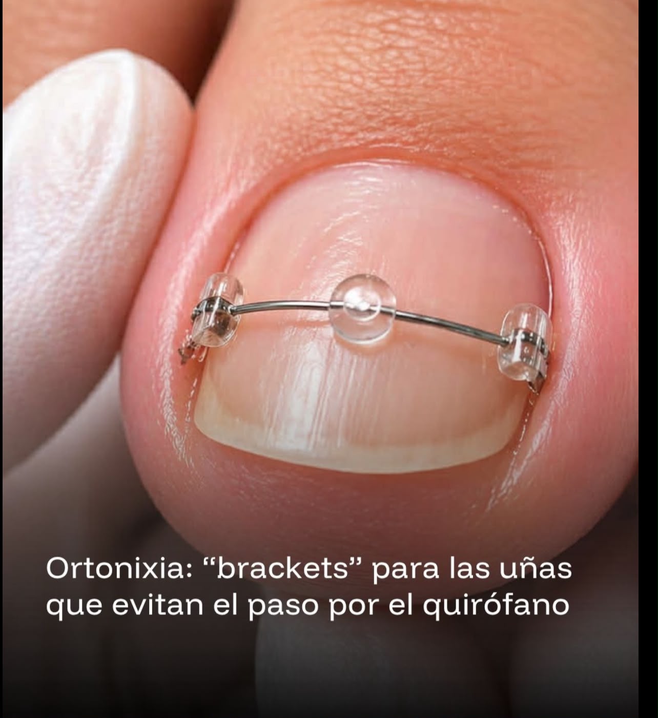 Ortonixia: corrector tipo brackets para guiar el crecimiento de la uña