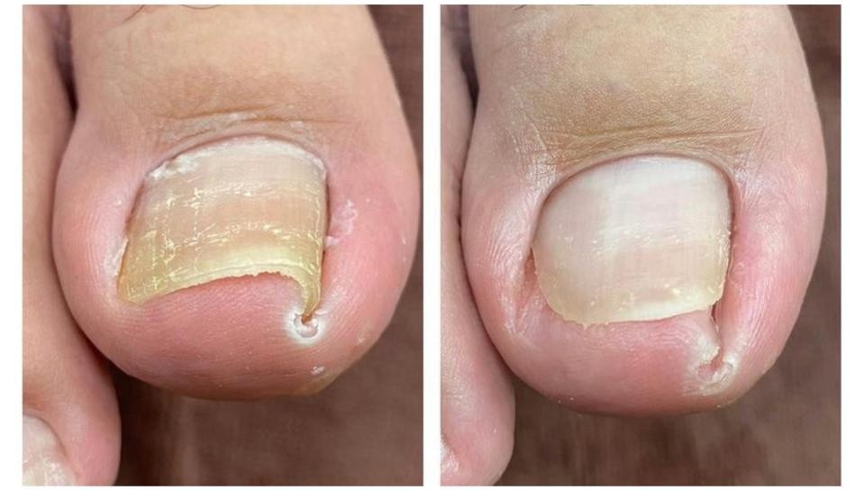 Cuidado de uña encarnada: antes y después de la atención podológica